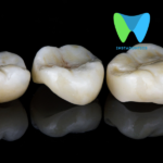 What causes tooth decay under a crown ?