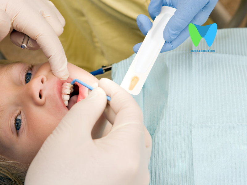 Dental Fluoride Varnish