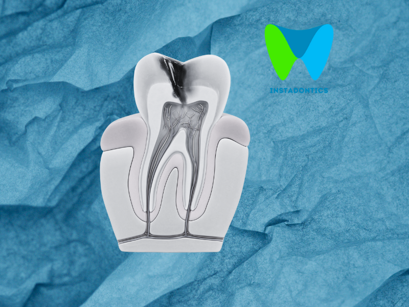 the cost of a root canal with insurance