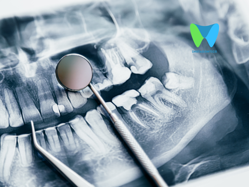 Dental Cyst vs Abscess