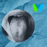 Geographic Tongue