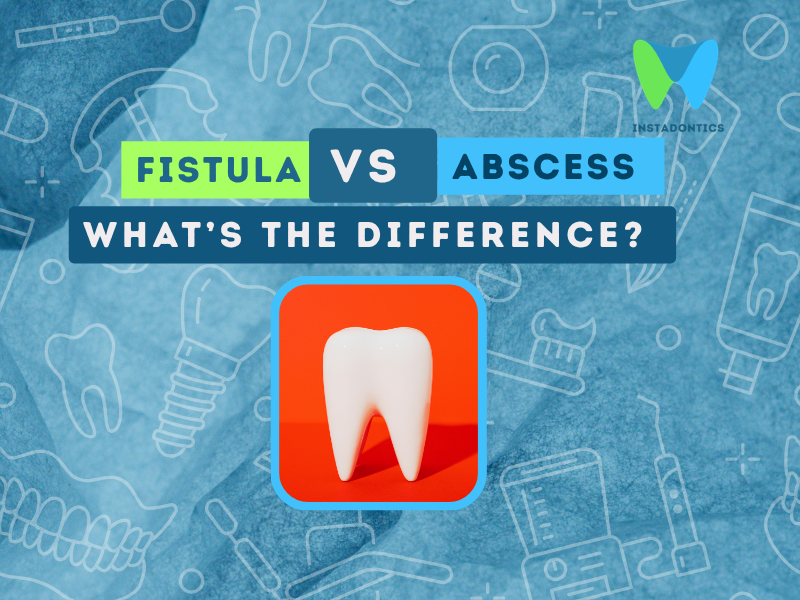 Fistula vs bscess