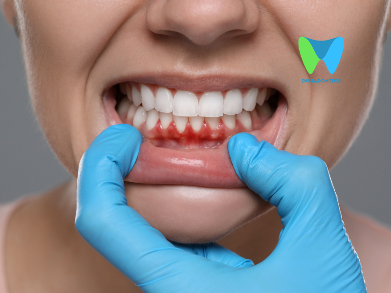 Fistula vs. Abscess in Dentistry