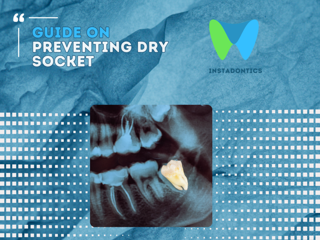 An Expert Guide to Prevent Dry Socket After Tooth Extraction