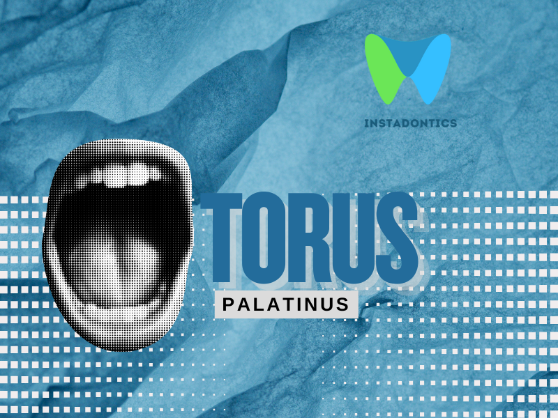 Torus palatinus