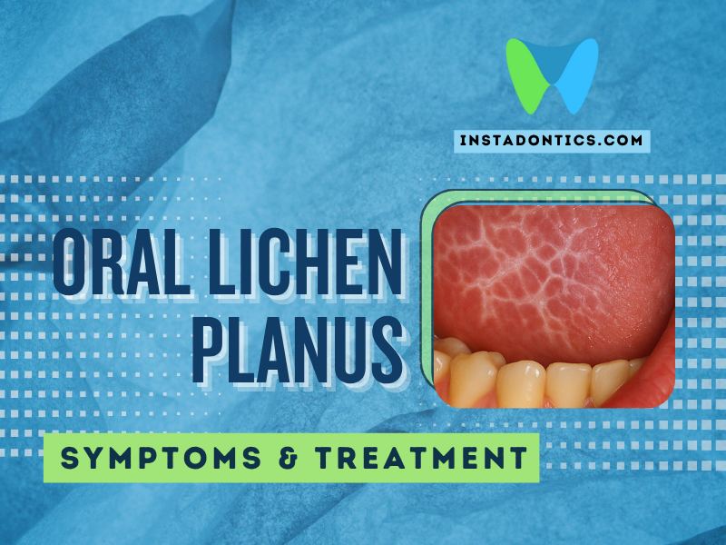 oral lichen planus symptoms