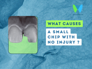 Small Chip Appeared on Tooth With No Memory of an Injury: Why It Happens