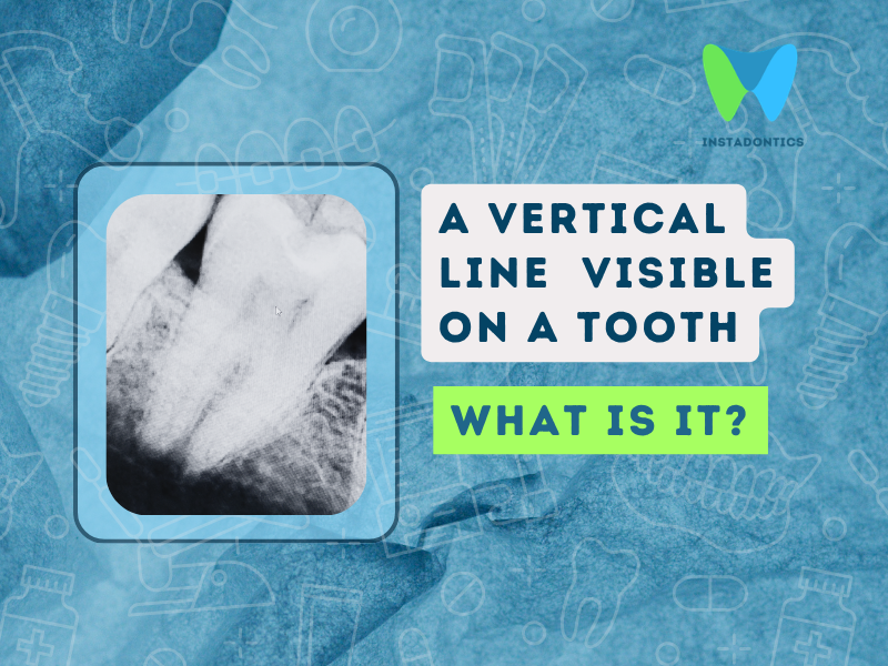 Vertical Line or Crack Visible on a Tooth